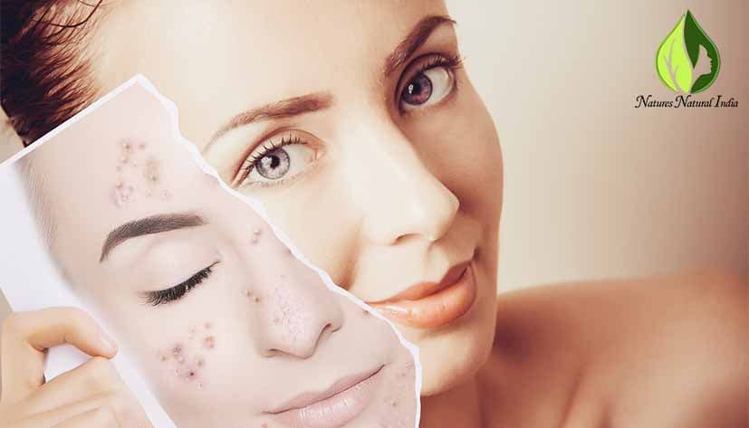 Bid farewell to acne with essential oils